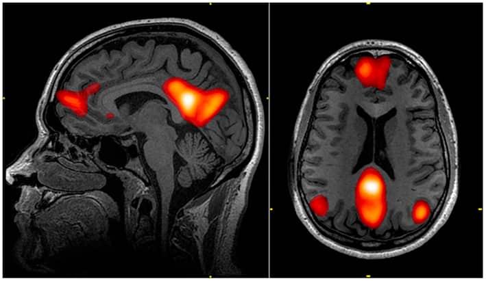 Mappa fMRI delle regioni del Default Mode Network del cervello umano