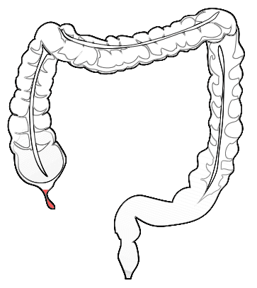 Schema anatomico che mostra la posizione dell'appendice rispetto al cieco e al colon