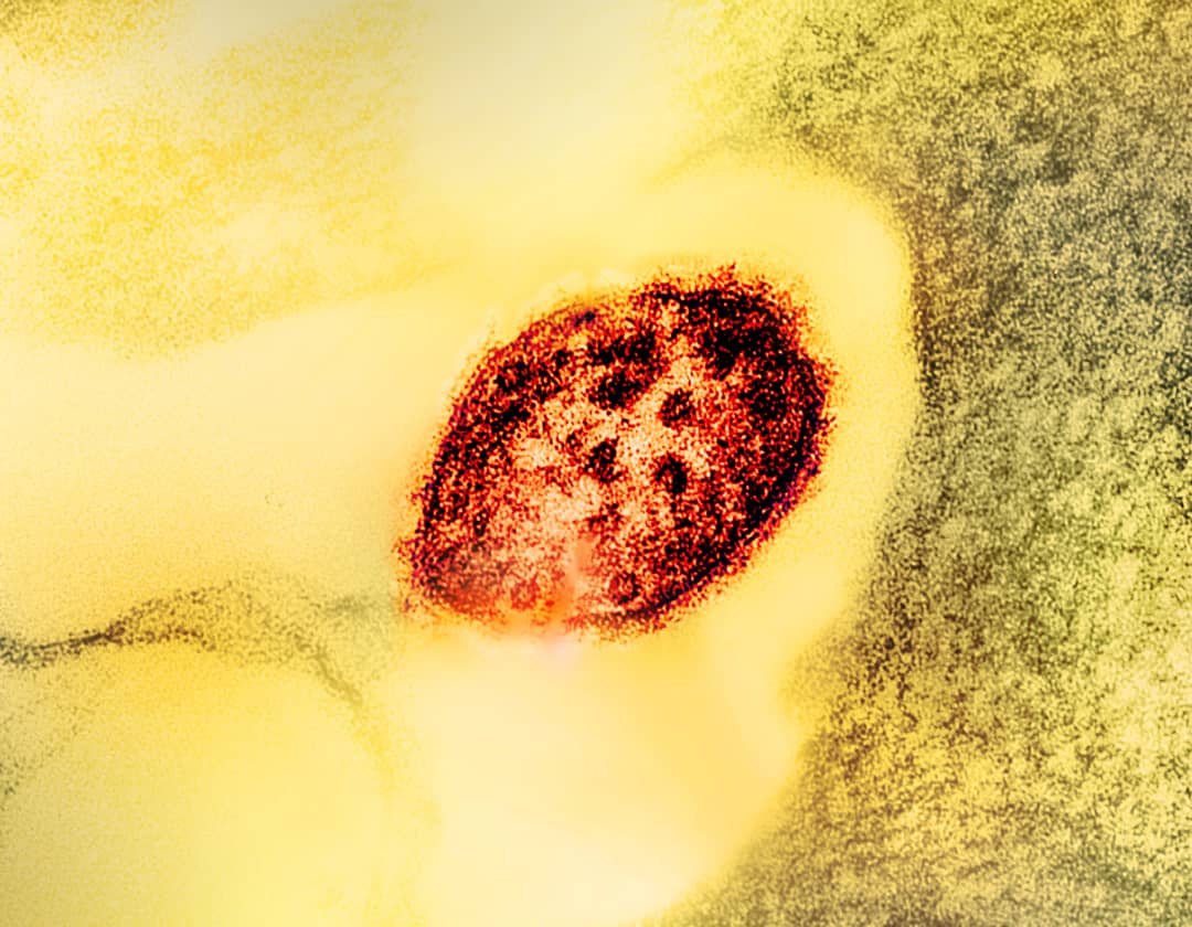 Microscopia elettronica di una particella del virus del morbillo