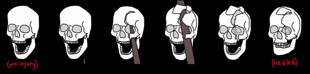 Ricostruzione della traiettoria della barra di ferro nel cranio di Phineas Gage