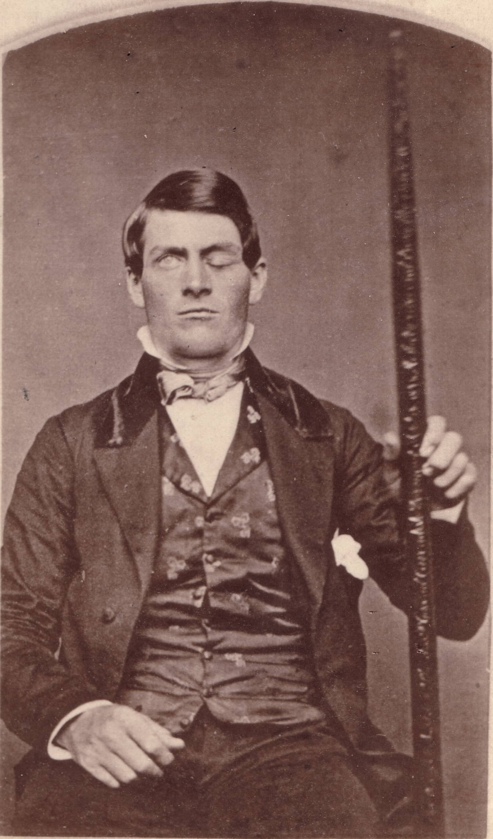 Phineas Gage tiene in mano la sbarra di ferro che gli trapassò il cranio nel 1848